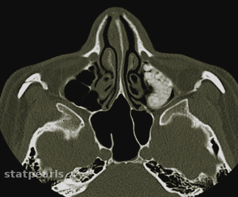 <p>Acute Sinusitis</p>