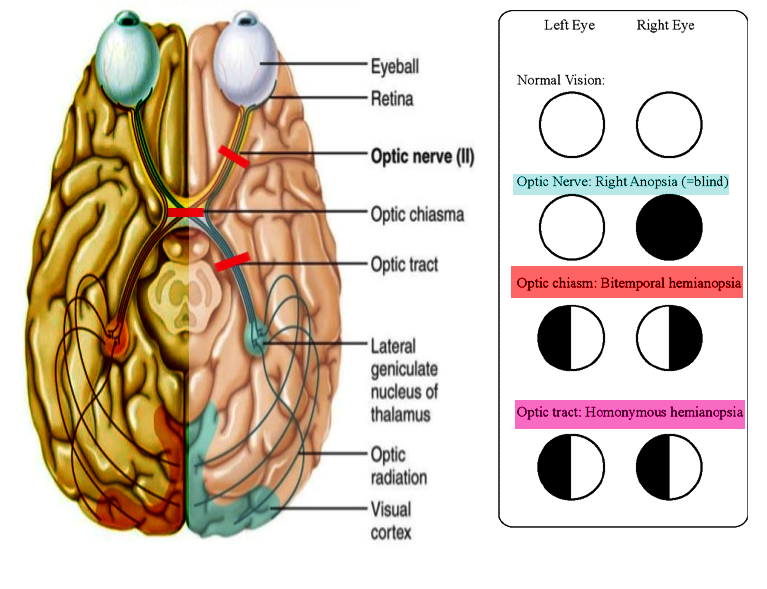 Optic tract injury