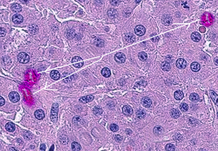 Leydig cell tumor