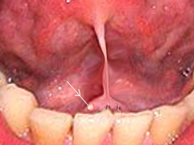 <p>Submandibular Stone. If large enough, these stones may be visually apparent on examination of the oral cavity.</p>