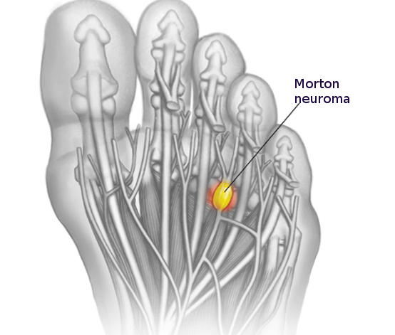 Morton neuroma