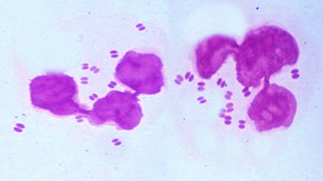 Neisseria gonorrhea (note diplococci)