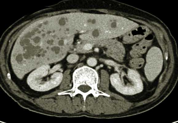 <p>Polycystic Liver Disease</p>