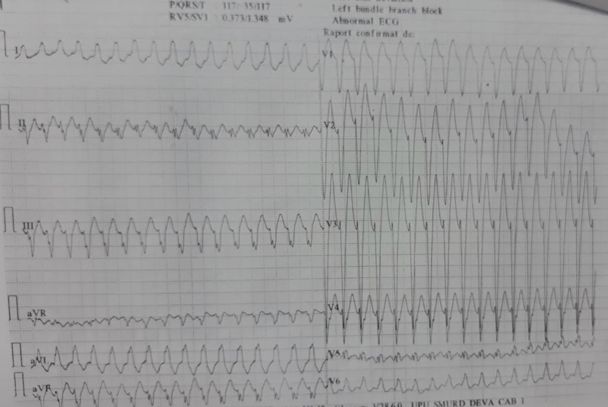 Ischemic ventricular tachycardia in a patient with an old inferior myocardial infarction