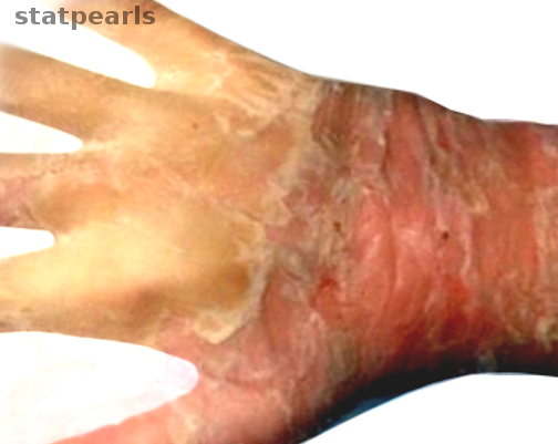 <p>Skin Fragility&nbsp;in Epidermolytic Hyperkeratosis