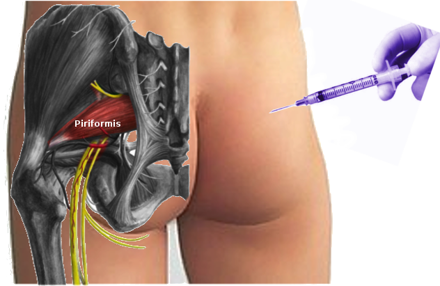 Piriformis injection