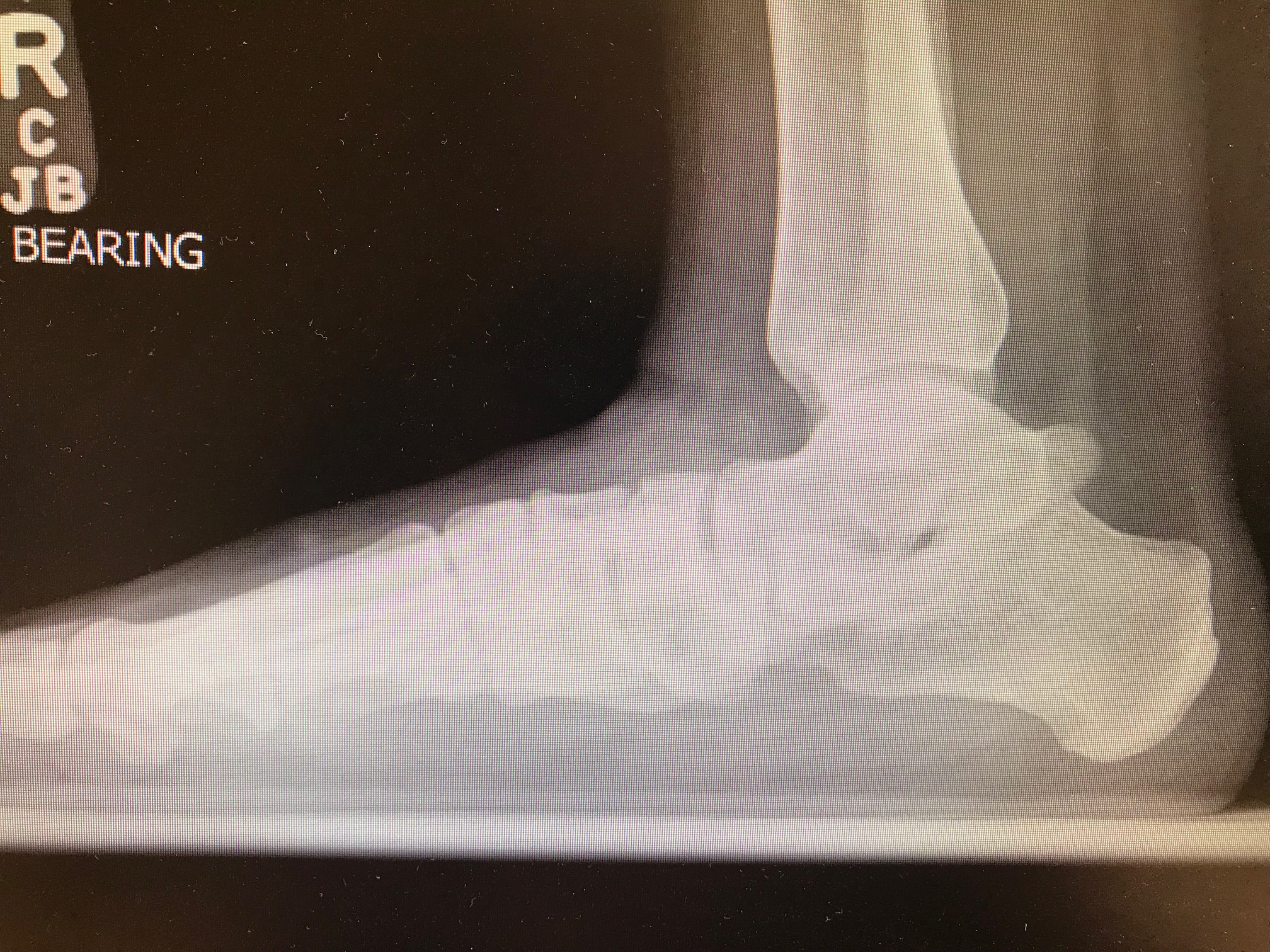 Triple Arthrodesis: pre-op weight bearing radiograph demonstrating acquired flatfoot deformity.