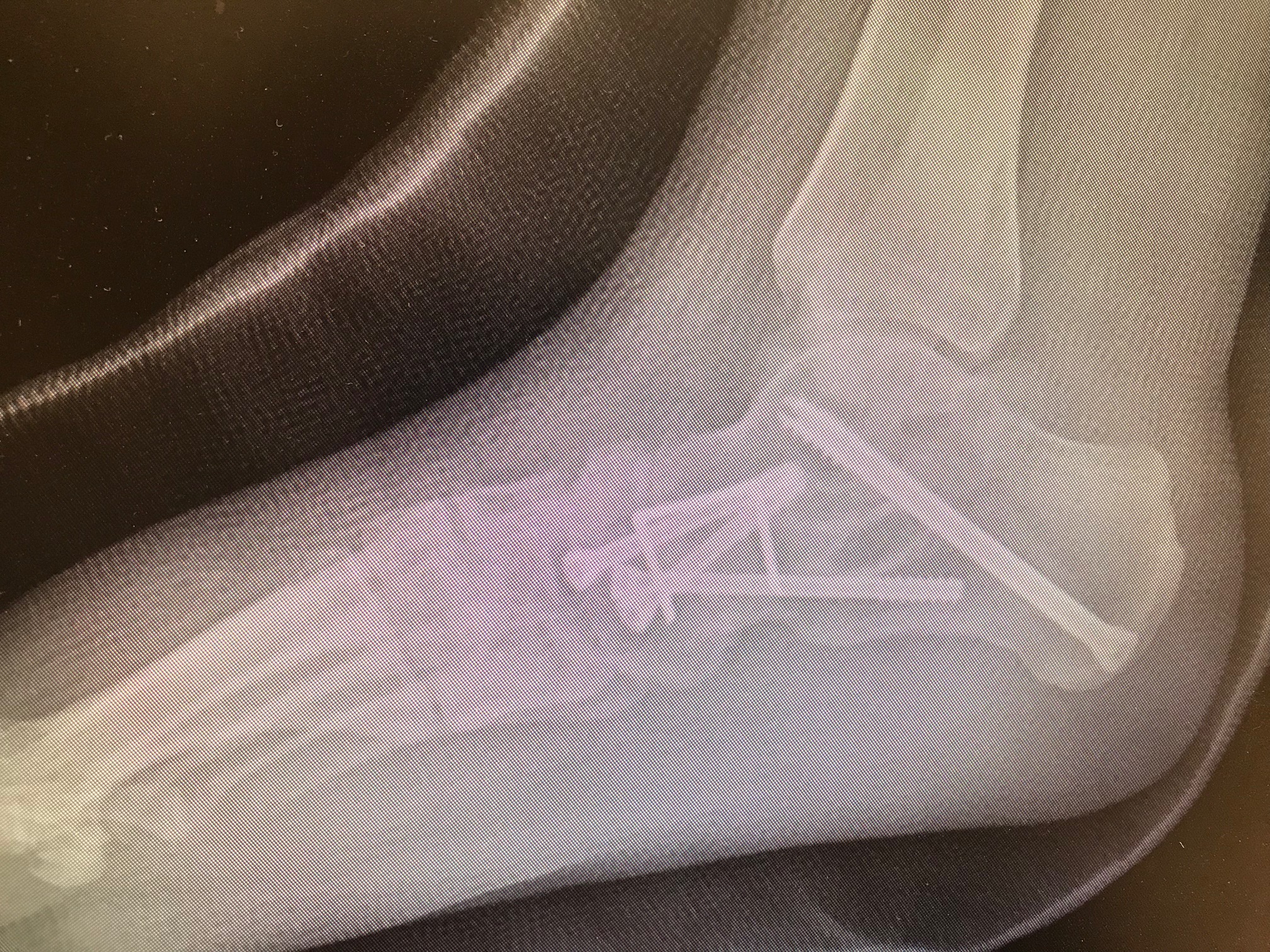 Triple Arthrodesis: lateral radiograph demonstrating fusions of subtalar, talona.vicular, and calcaneo-cuboid joints