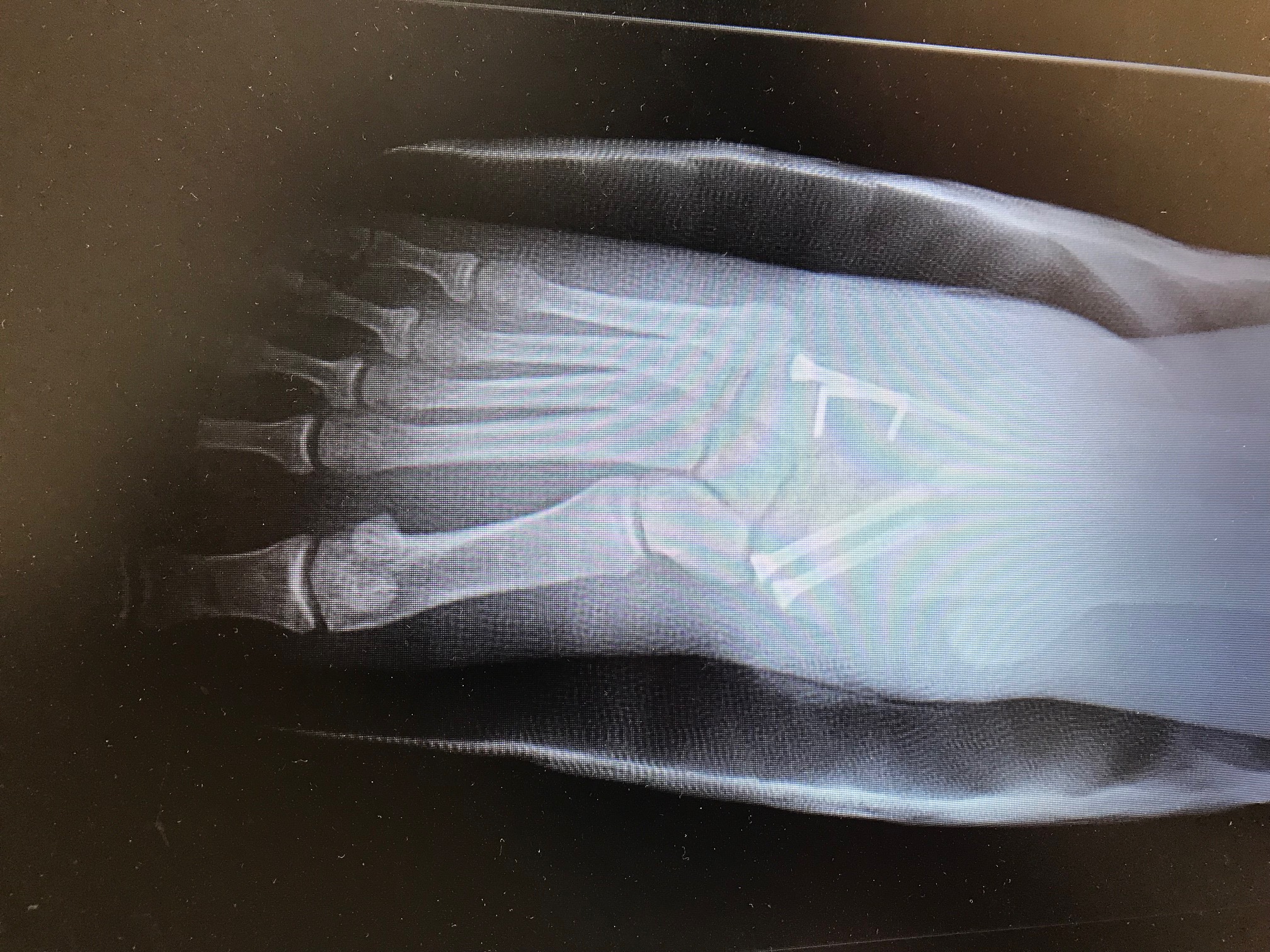 Triple Arthrodesis: dorsal-plantar radiograph demonstrating fusions of subtalar, talona.vicular, and calcaneo-cuboid joints