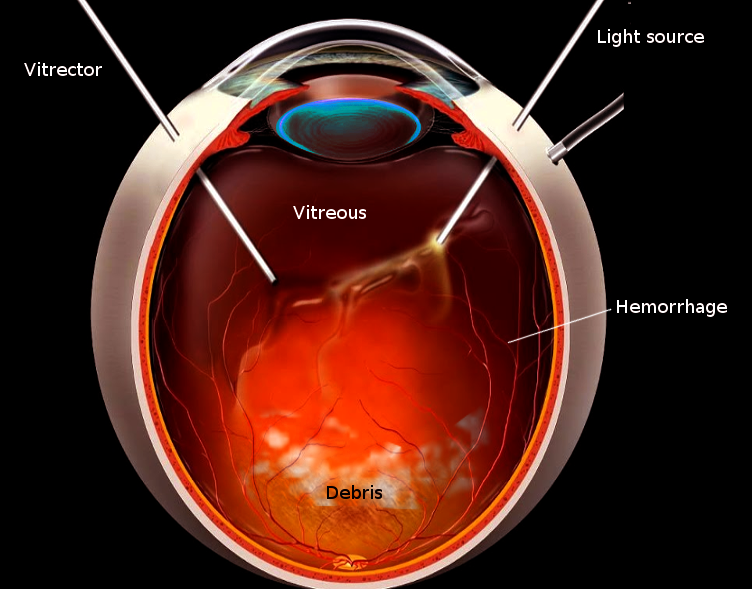 Vitrectomy