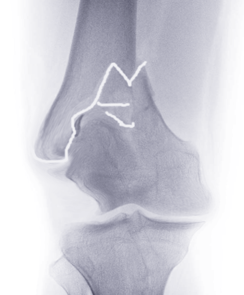 Distal femur fracture