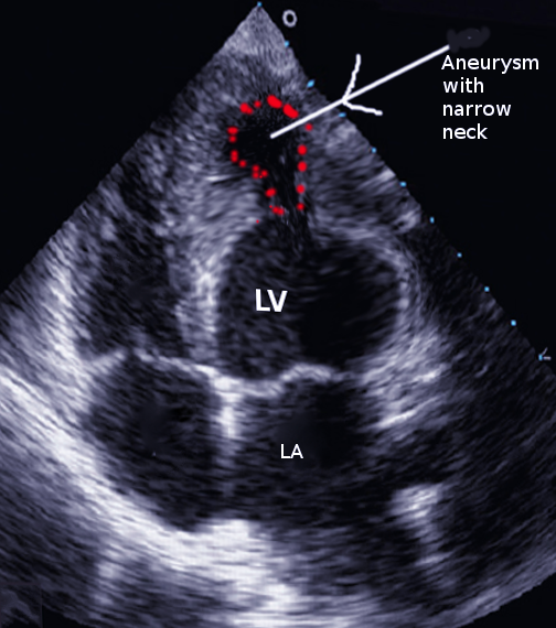 <p>Left Ventricular Aneurysm</p>