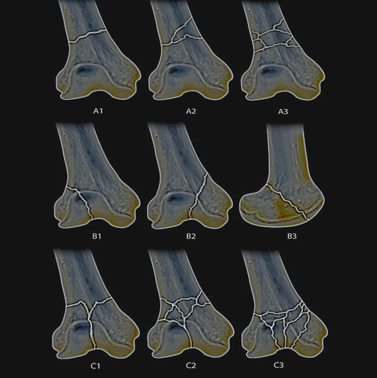 Distal femur fx classification