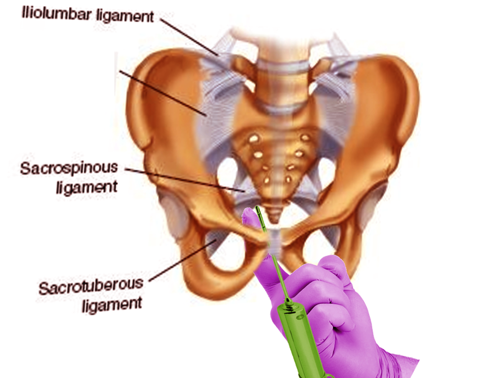 <p>Pudendal Nerve Block</p>