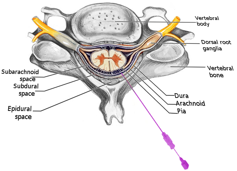 <p>Spinal Block</p>