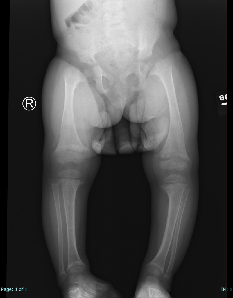 Single AP view from a leg alignment study demonstrates metaphyseal flaring (widening) of the distal femurs as well as proximal and distal tibial metaphyses. There is also tibial shaft inbowing in this 2 year old female with a known history of rickets. 