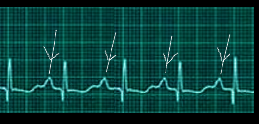 Right atrial enlargement