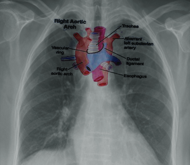 <p>Right Aortic Arch</p>