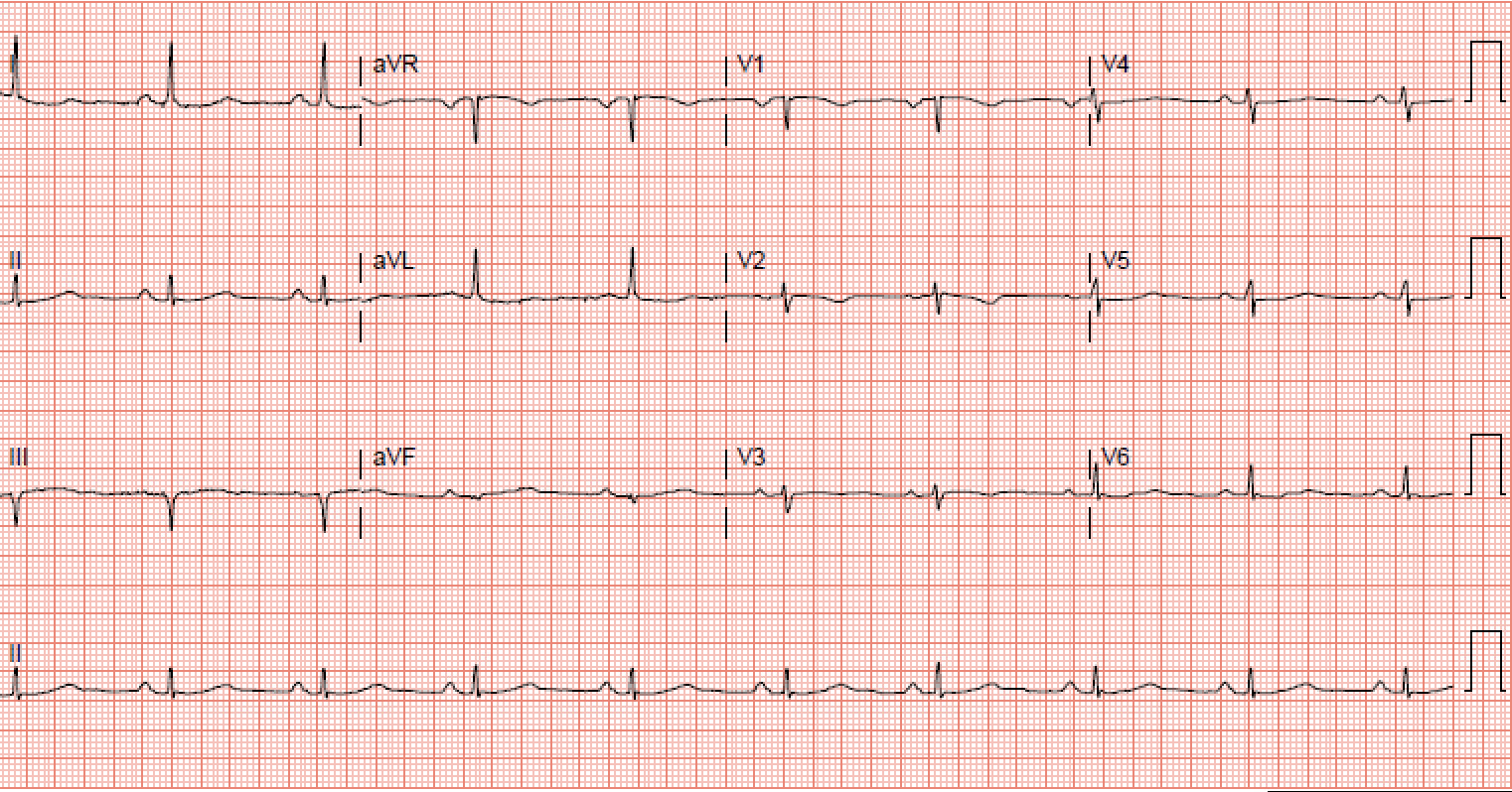 sinus bradycardia