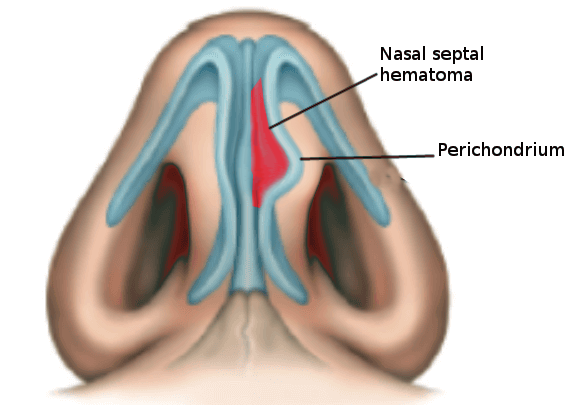 <p>Nasal Septal Hematoma. This illustration shows a nasal septal hematoma along with the perichondrium of the nose.</p>