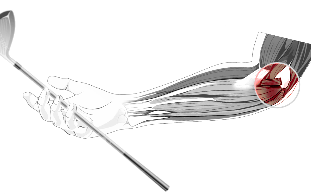 <p>Golfer's Elbow</p>