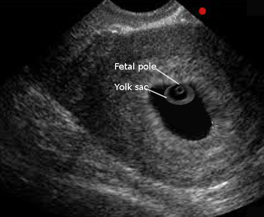 Normal gestational sac