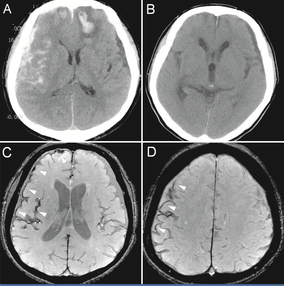 Original description: Figure 2. CT and enhanced gradient echo T2 star-weighted angiography (ESWAN) images of the brain of a 54-year-old man who experienced a traumatic brain injury. An axial head CT image displays right frontotemporal SAH (Fisher grade 4) with bilateral frontal contusions and intracerebral hematoma (A). A follow-up CT image 26 weeks after the brain injury indicates that the hemorrhages were completely resolved and the lateral ventricles were mildly enlarged (B). A follow-up MRI (1.5T) image was obtained 26 weeks following the head injury (C,D). The axial ESWAN image displays a rim of hypointensity (arrowheads), with hemosiderin deposits forming along the cerebral convexity (C, D).