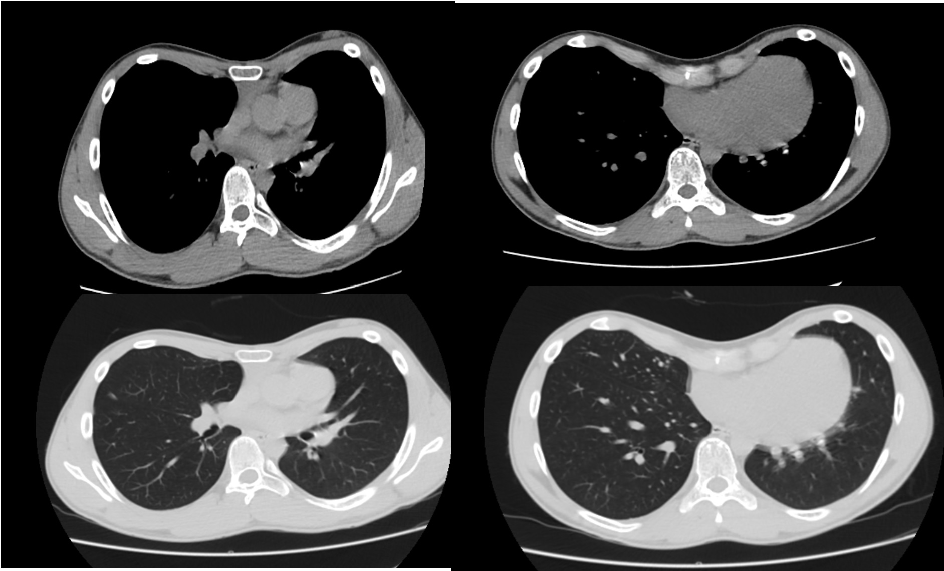 At the computerized chest scan of thorax, pectus excavatum was seen, and the heart was pushed to the right side.