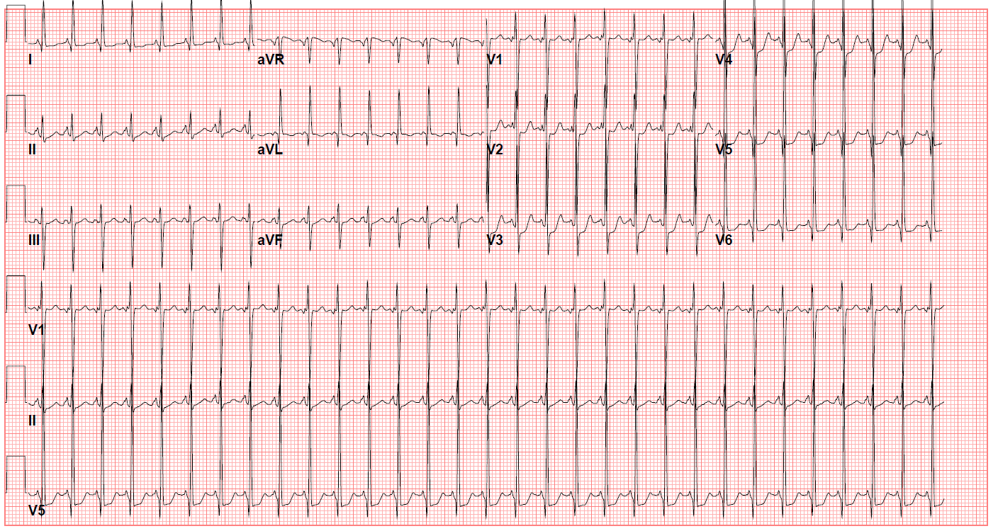 EKG in a patient with tricuspid atresia showing left axis deviation