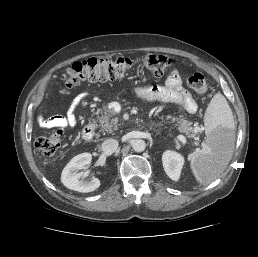 <p>Splenic Infarcts