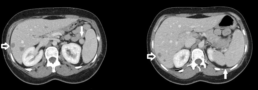 <p>Splenule