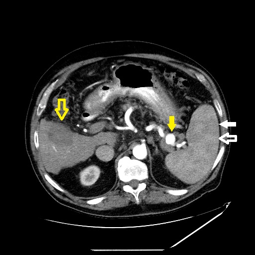 <p>Heterogeneous Splenic Enhancement