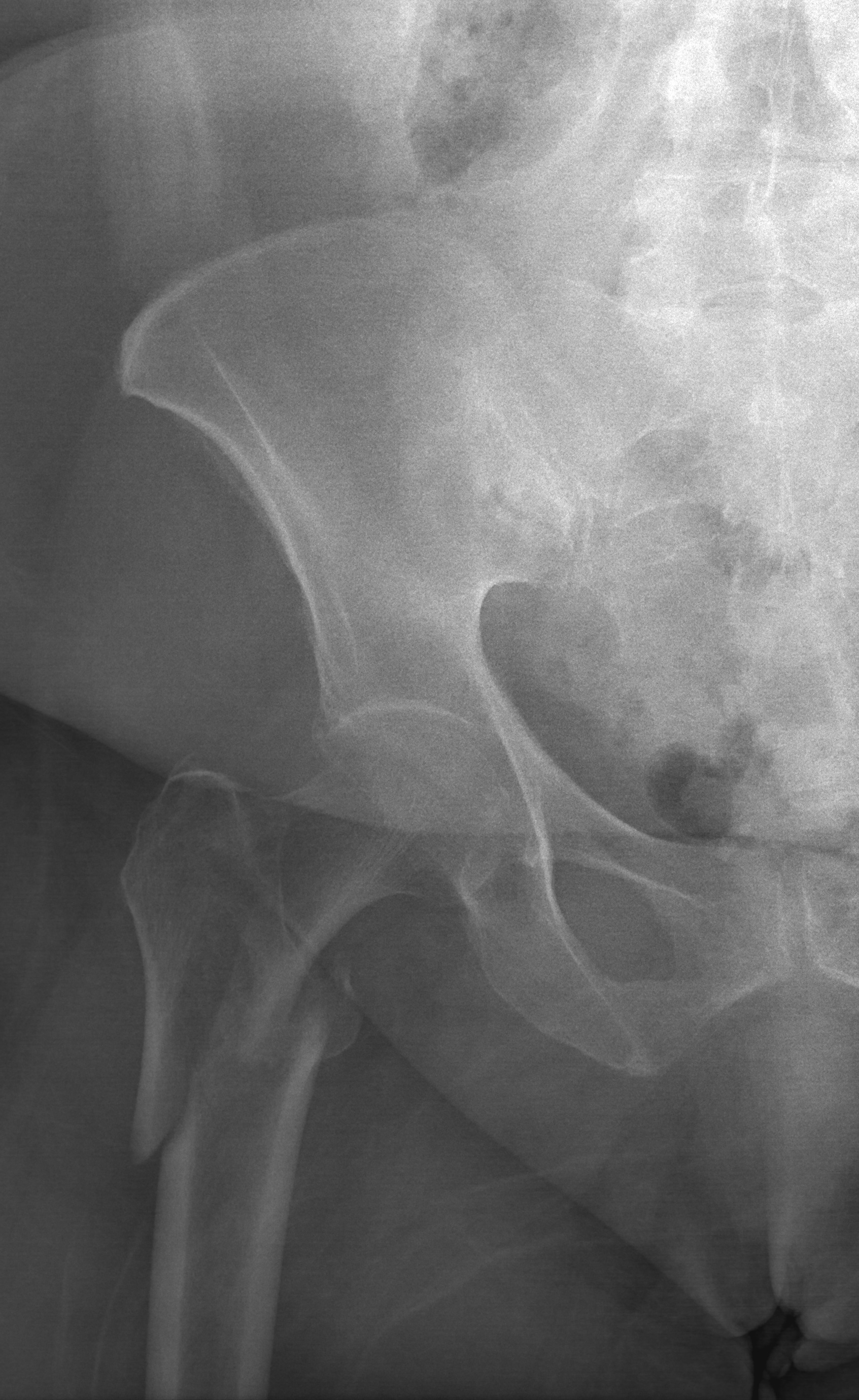 Reverse Obliquity Intertrochanteric femur fracture