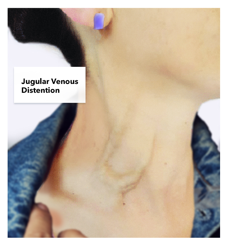 Jugular Venous Distention