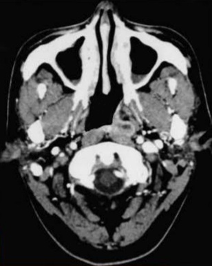 <p>Nasopharyngeal Mass