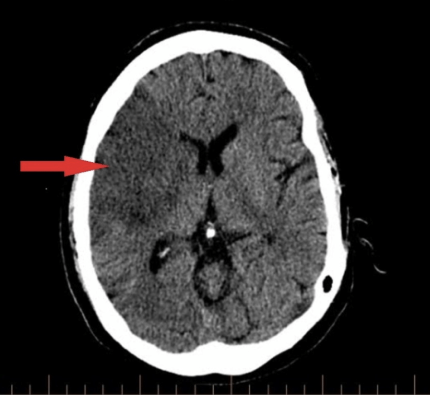 <p>Right Middle Cerebral Artery Stroke</p>