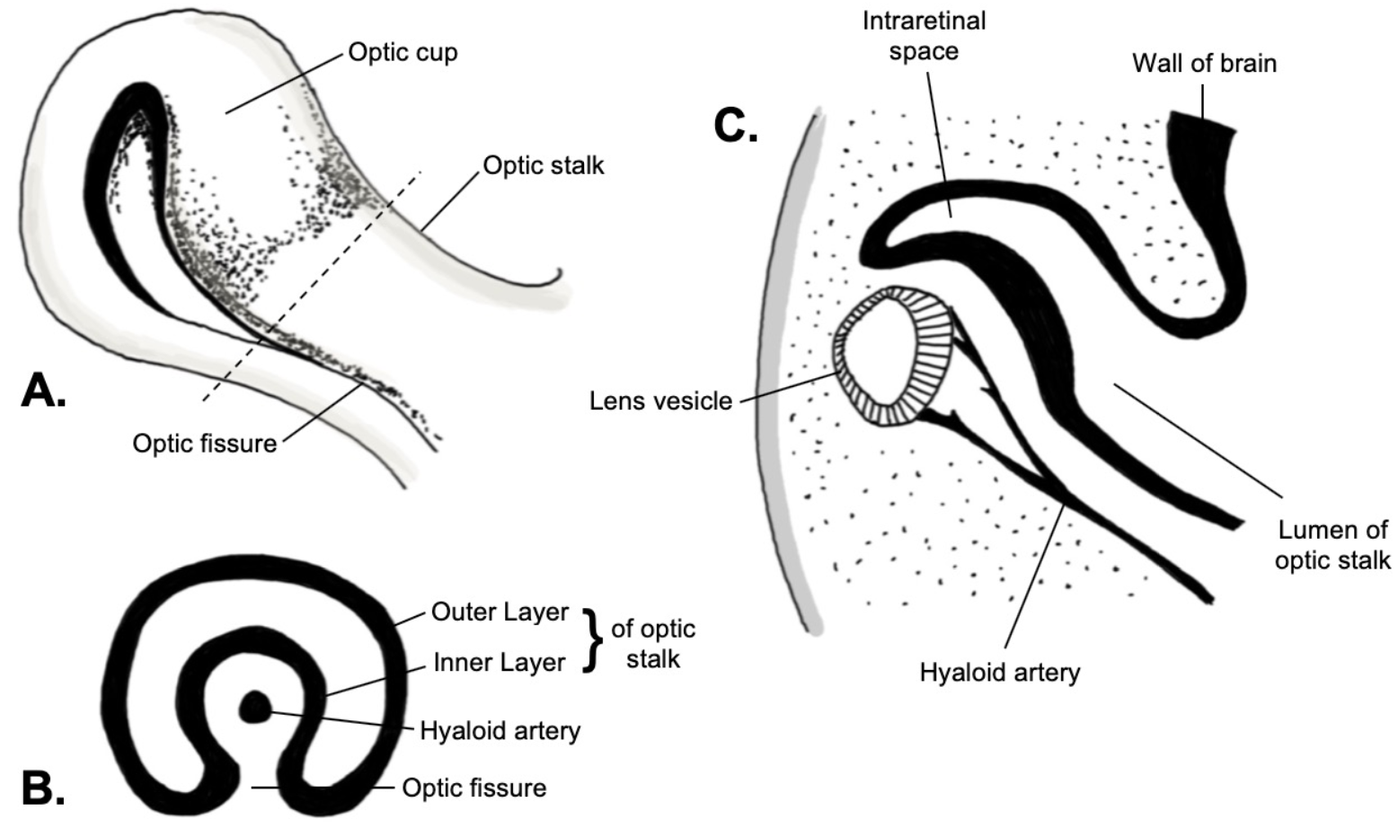 <p>Embryology of the Optic Fissure. Lateral view (A). Coronal cross section (B). Sagittal cross section (C).</p>