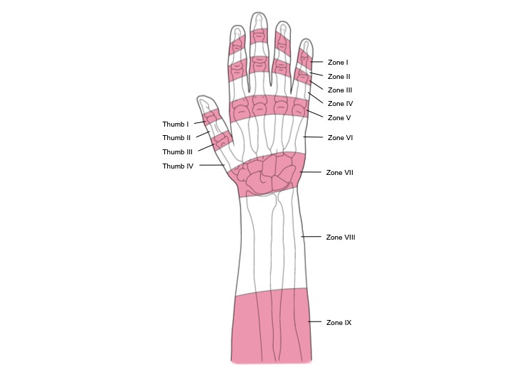 <p>Extensor Tendon Zones in the Hand