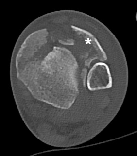 Transverse CT of a pilon fracture demonstrating a comminuted anterolateral fragment (Chaput).