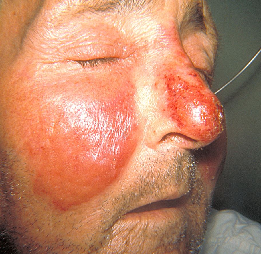 <p>Erysipelas Rash</p>