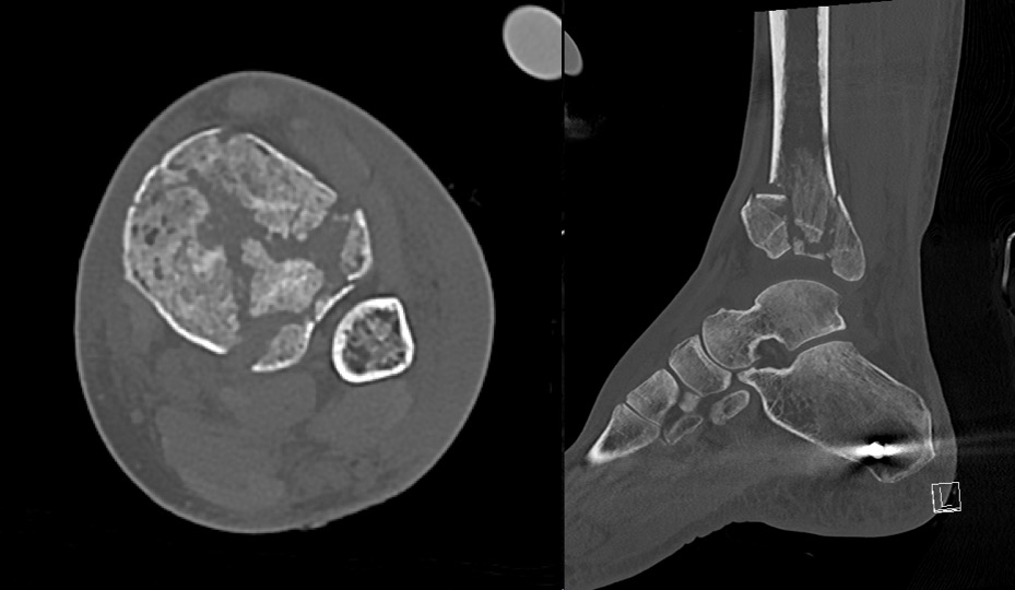 Axial and sagittal CT slices of a pilon fracture after external fixation placement