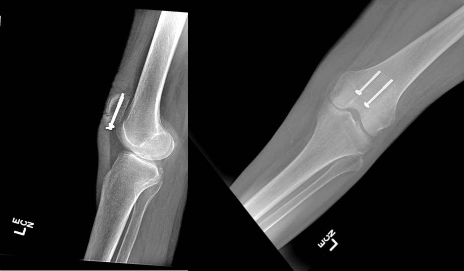 Lateral and AP XRs of left knee after ORIF of patella fracture using cannulated partially threaded screws