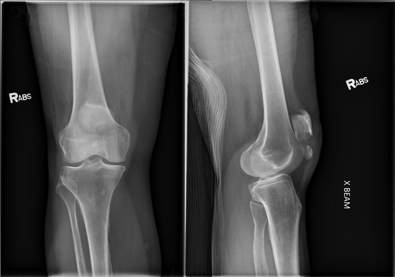 AP and lateral XR of a right knee that shows inferior pole patella fracture with significant gapping.