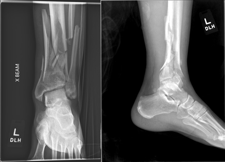 AP and lateral XR of left pilon fracture