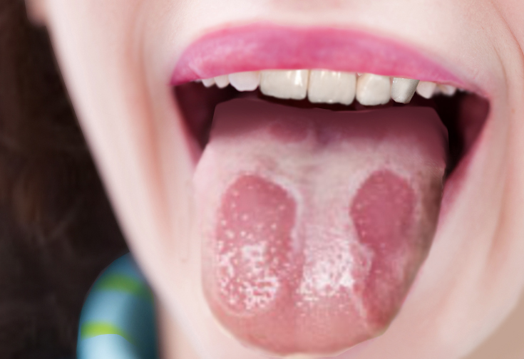 <p>Geographic tongue</p>