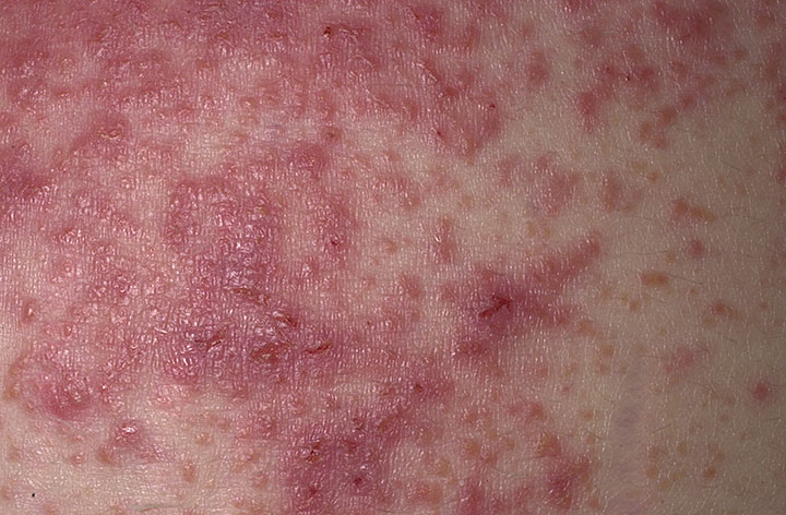 dermatitis herpetiformis