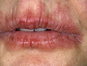 <p>Atopic cheilitis</p>