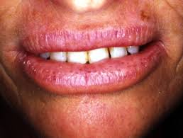 <p>Glandular Cheilitis</p>