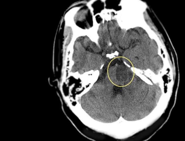 <p>Pontine infarction</p>