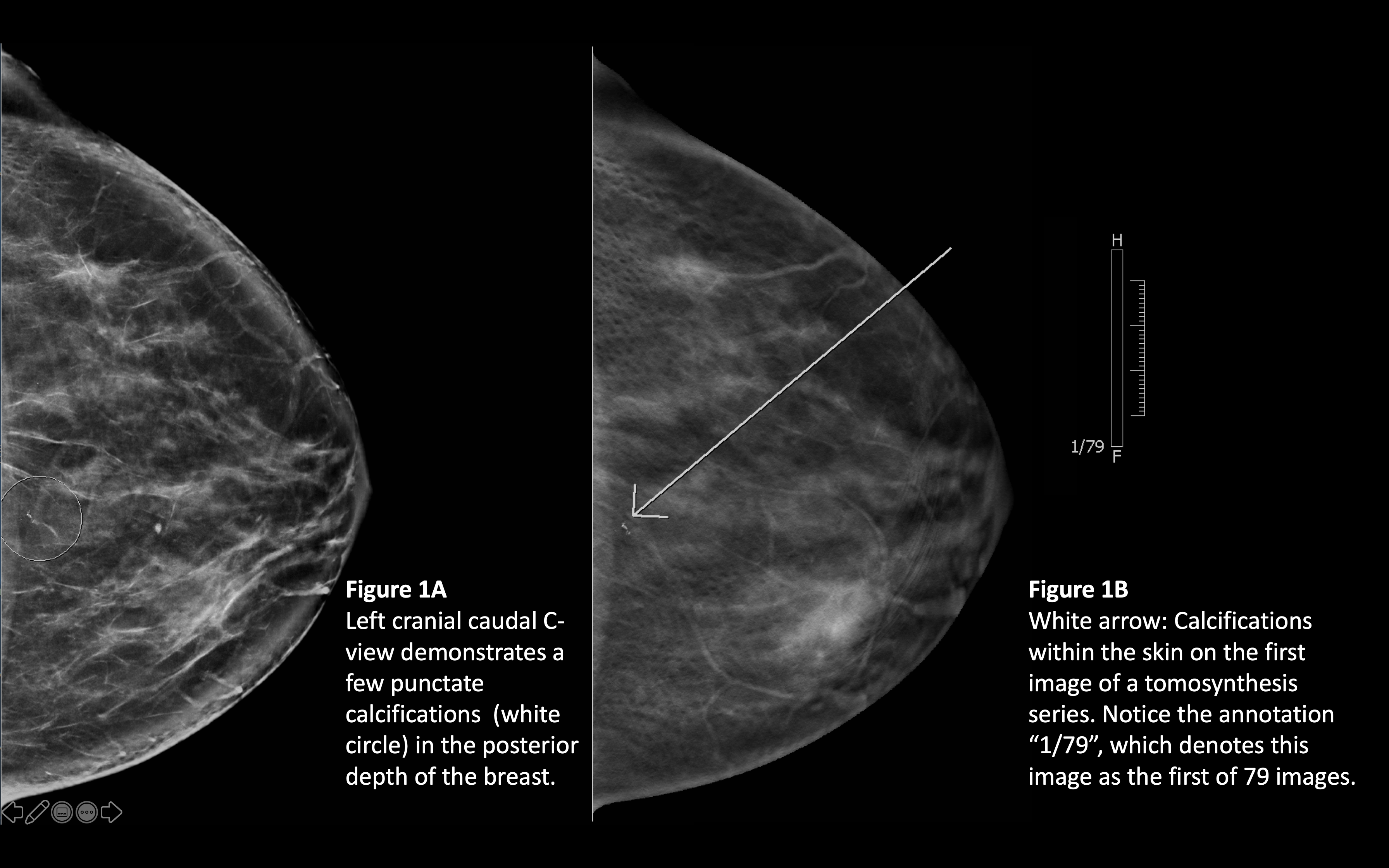 skin calcifications